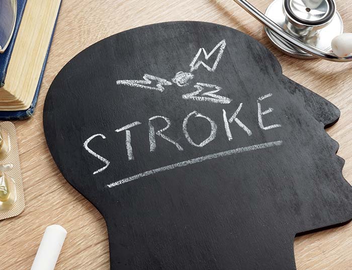 Managing Strokes in Older Adults